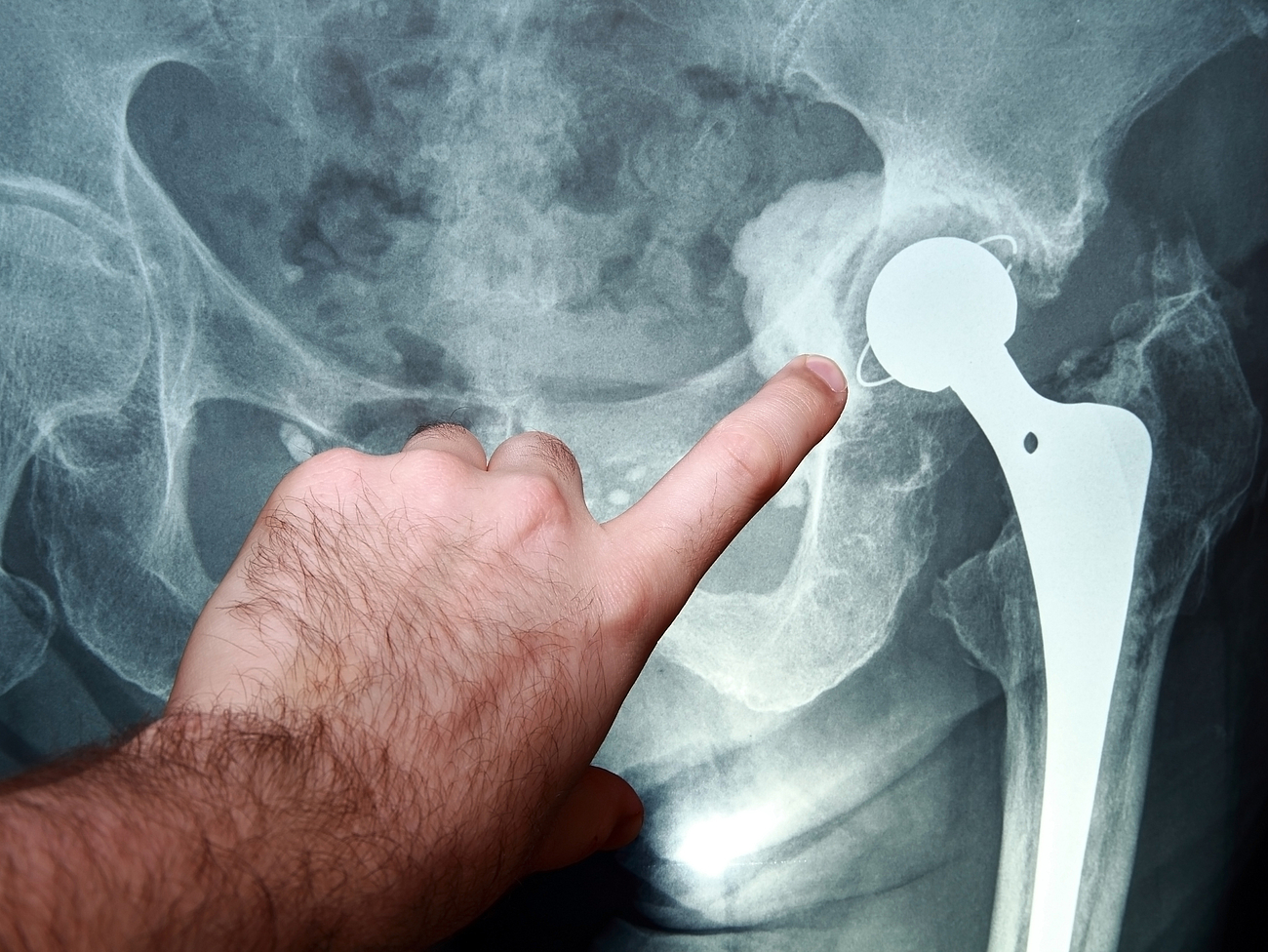 Röntgenaufnahme eines künstlichen Hüftgelenks KHA_fotolia_OSH.jpg